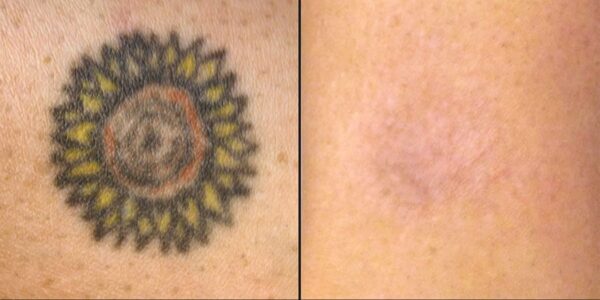 Laser pour rajeunissement de la peau – Image 5