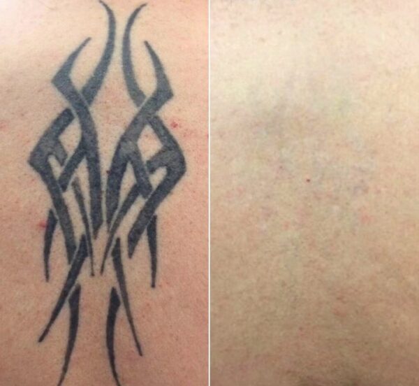 Laser pour rajeunissement de la peau – Image 4